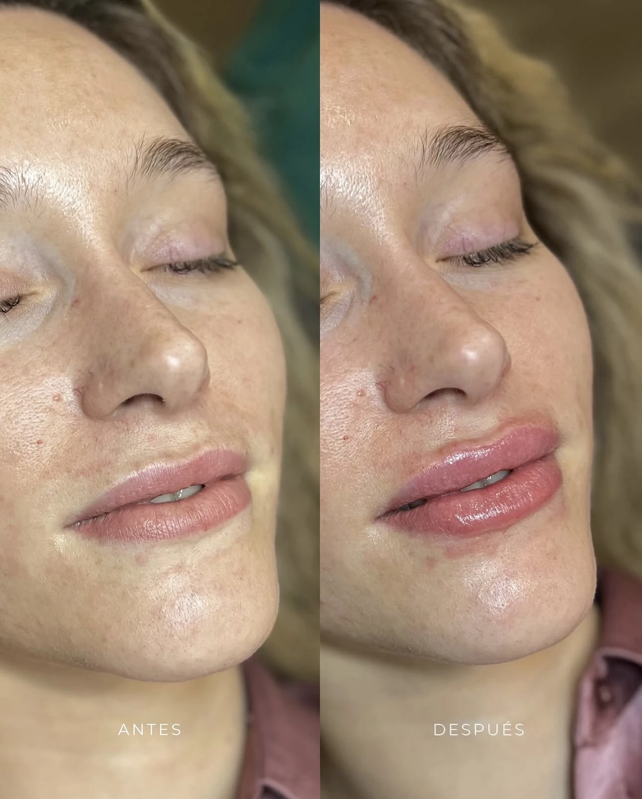 Antes y después de aumento de labios en Lumea