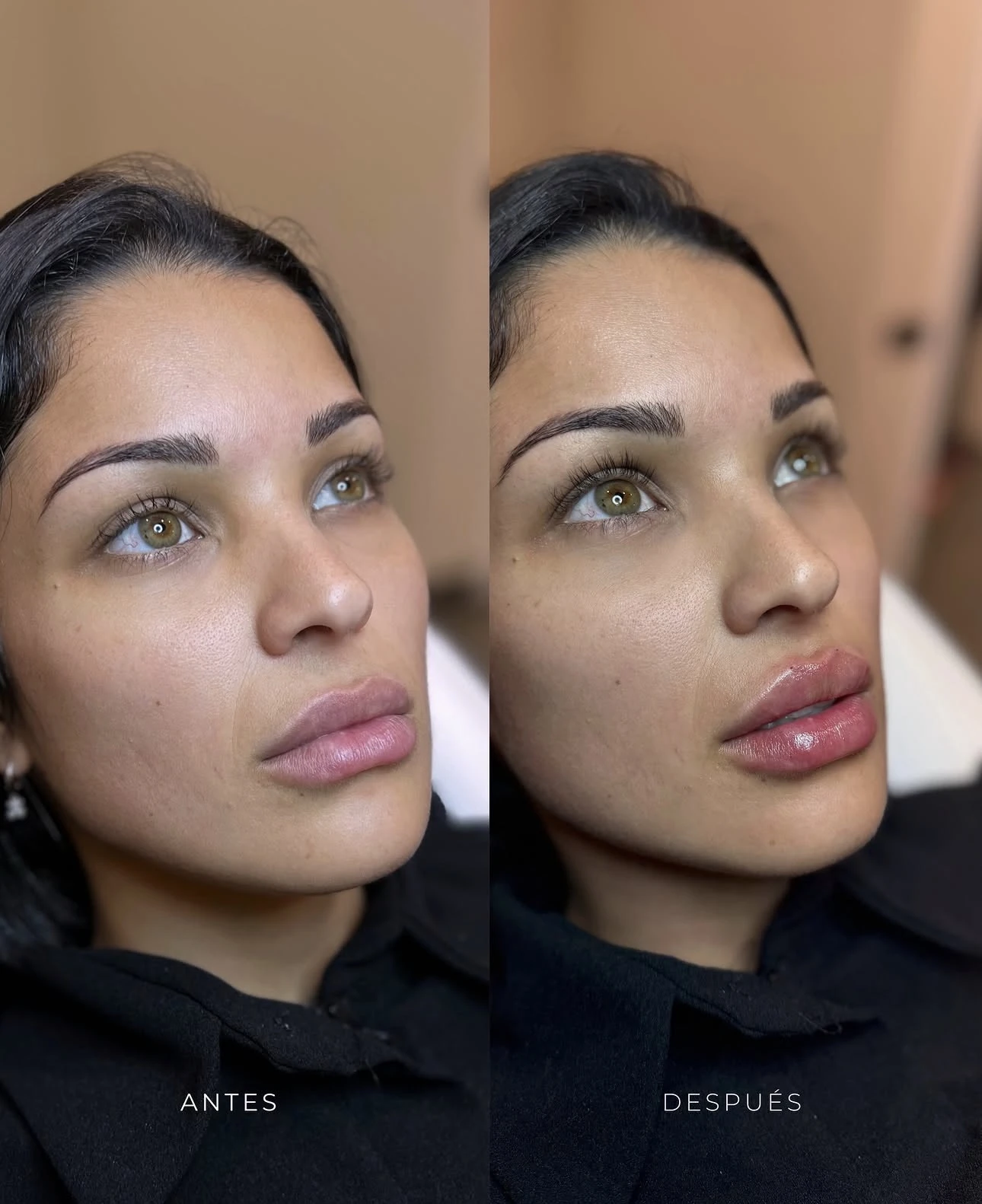 Antes y después de tratamiento facial en Lumea