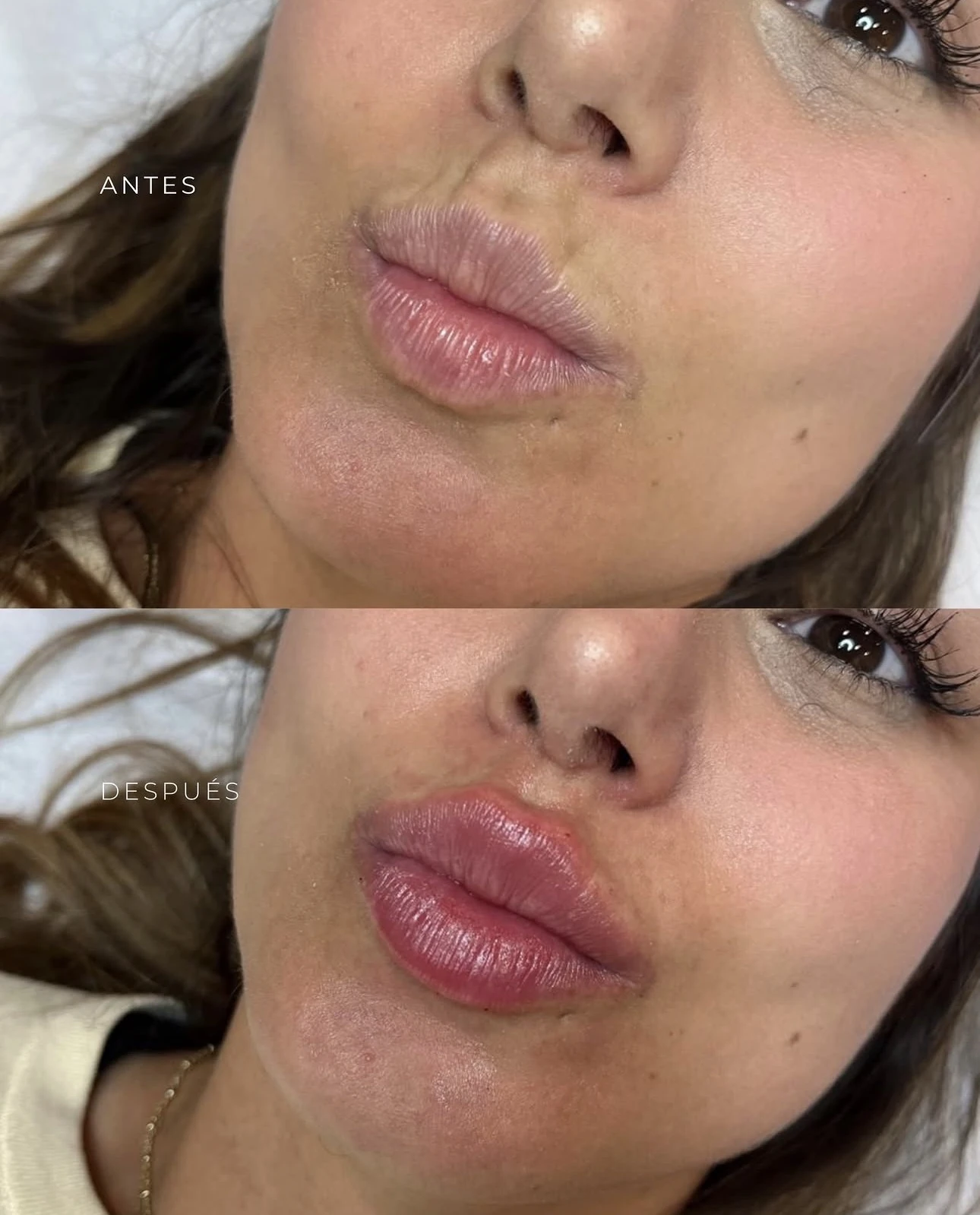 Antes y después de tratamiento facial en Lumea