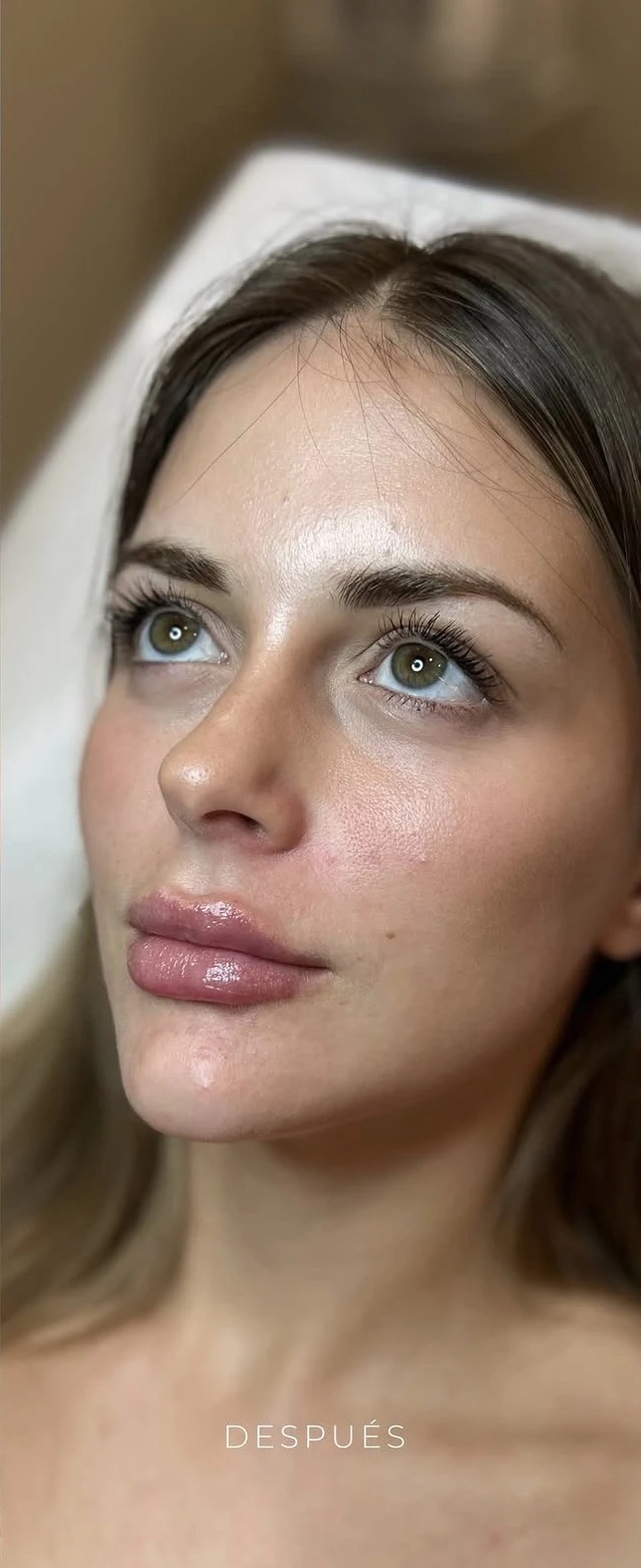 Después de armonización facial en Lumea