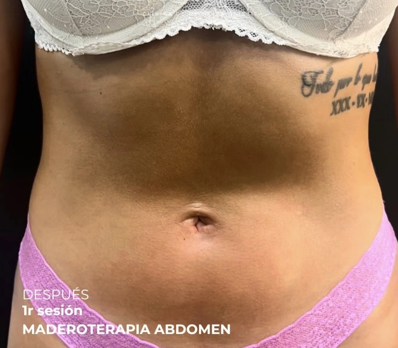 Después de maderoterapia de abdomen en Lumea