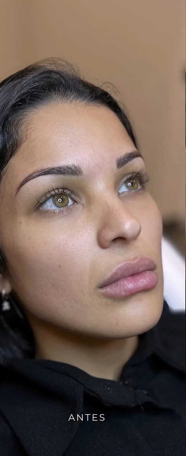 Antes de rejuvenecimiento facial en Lumea