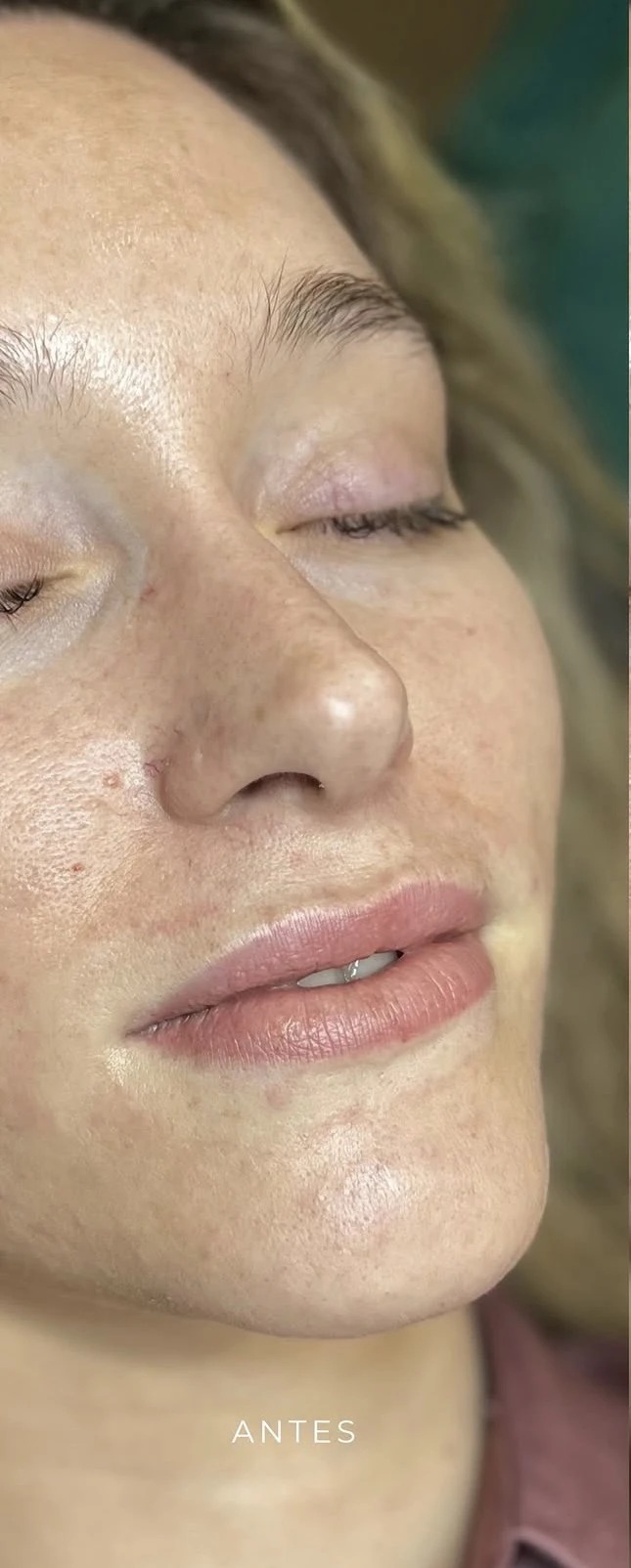 Antes de aumento de labios en Lumea