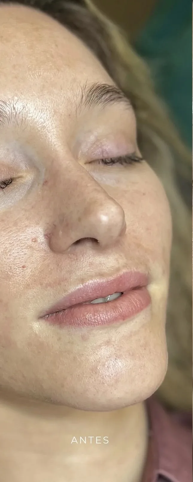 Antes de aumento de labios en Lumea