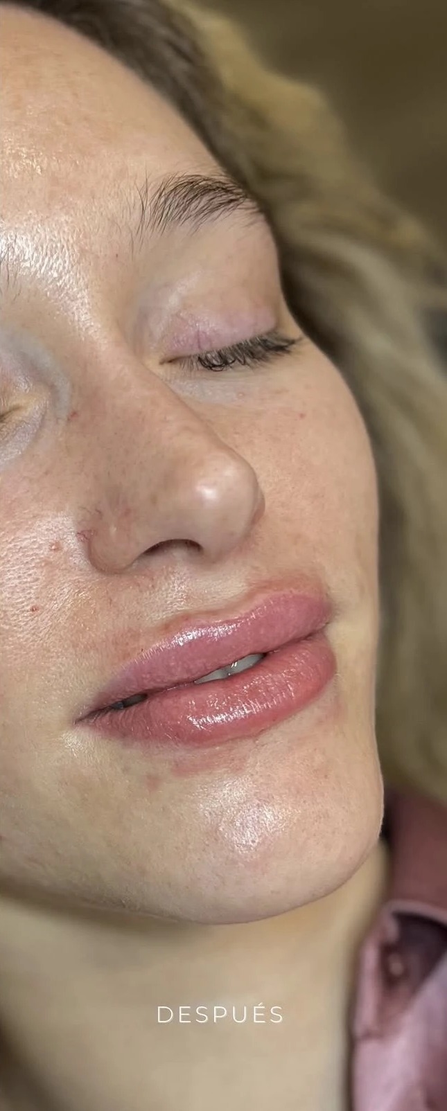 Después de aumento de labios en Lumea