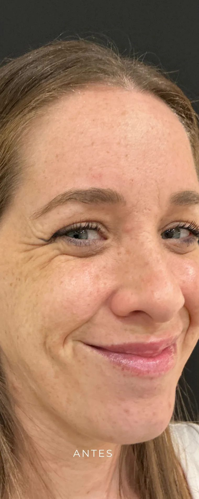 Antes de tratamiento facial en Lumea