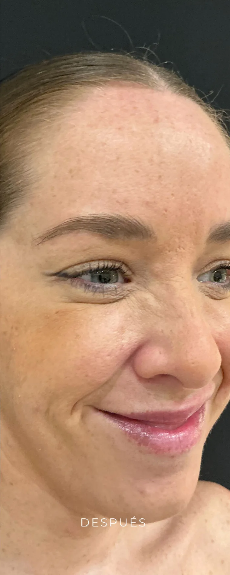 Después de tratamiento facial en Lumea