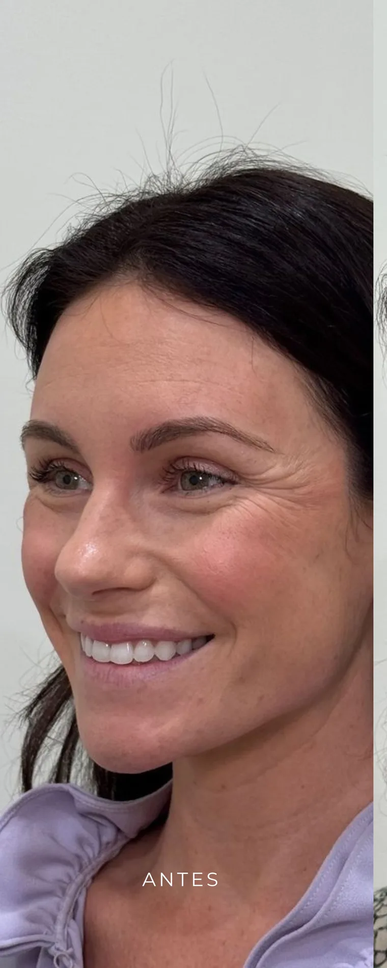Antes de tratamiento facial en Lumea