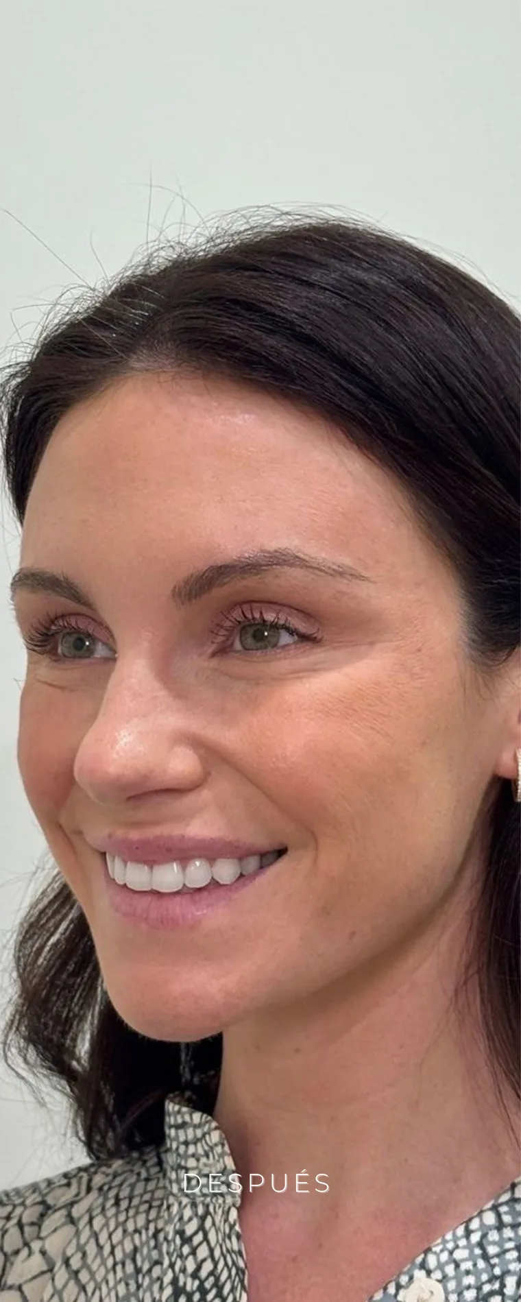 Después de tratamiento facial en Lumea