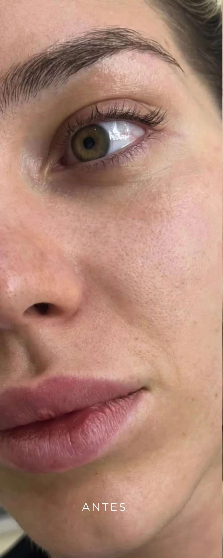 Antes de aumento de labios en Lumea