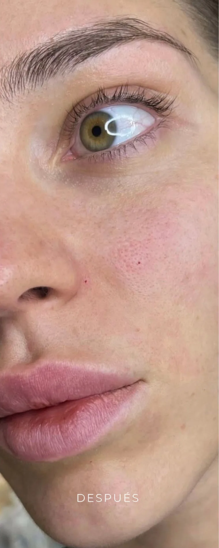 Después de aumento de labios en Lumea