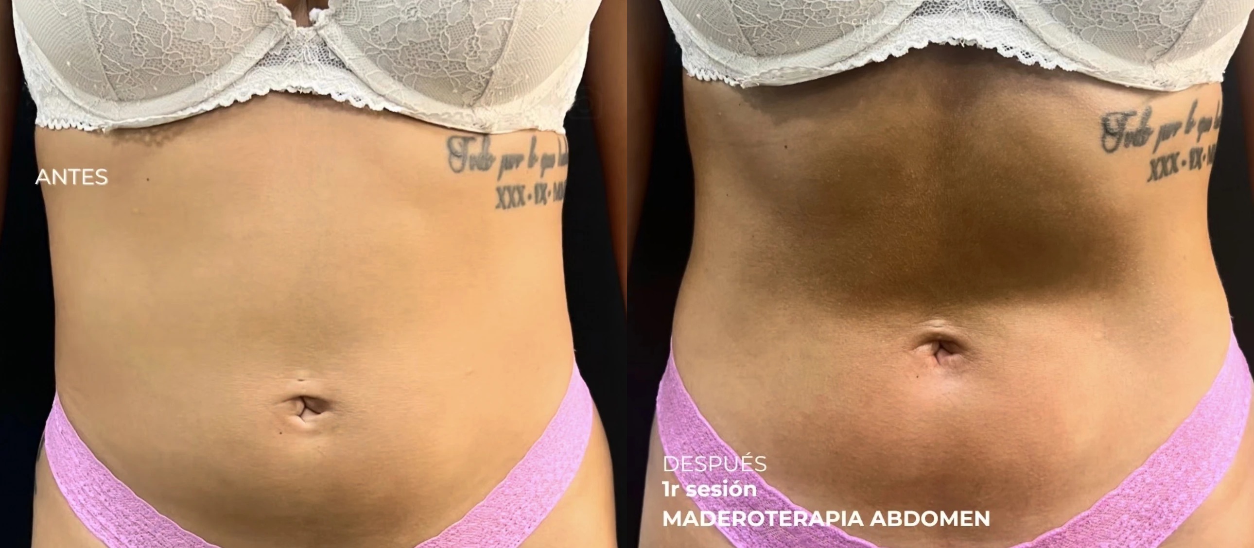 Antes y después de maderoterapia de abdomen en Lumea